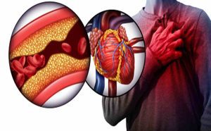 Heart Blockage Signs