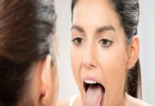 Vitamin-B12 Deficiency