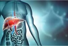 Fatty Liver Management Tips