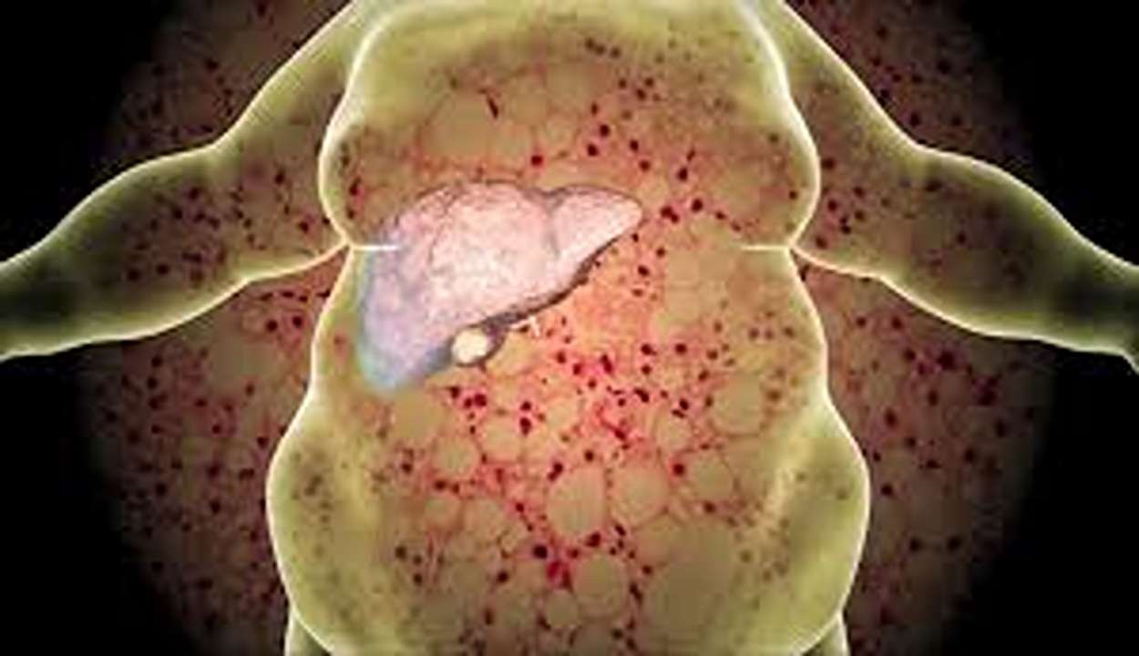 Fatty Liver Recovery Diet