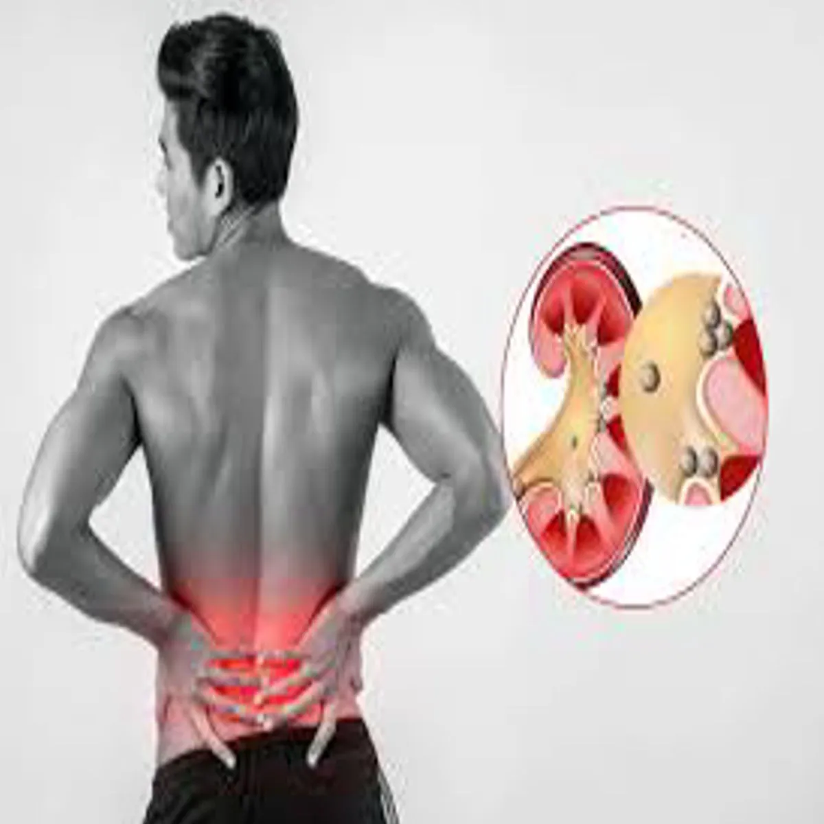 Kidneystone Kidneystone Kya Biyr Sch Men