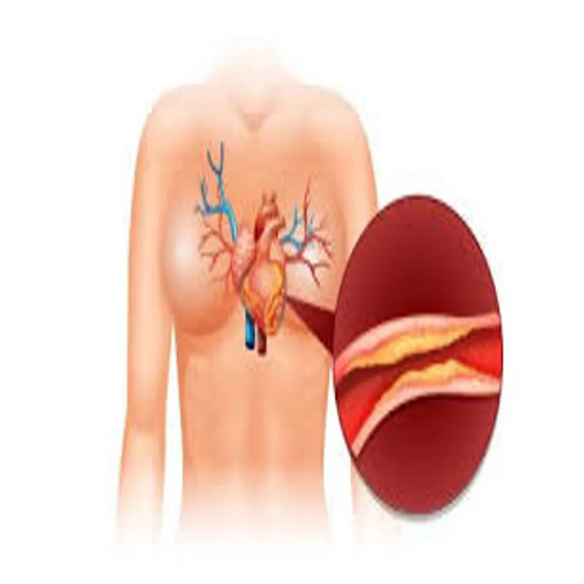 Triglycerides Triglycerides Bdhta Str Dil Livr
