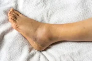 Kidney - – - पैरों - का - दर्द - और - सूजन - बीमारी