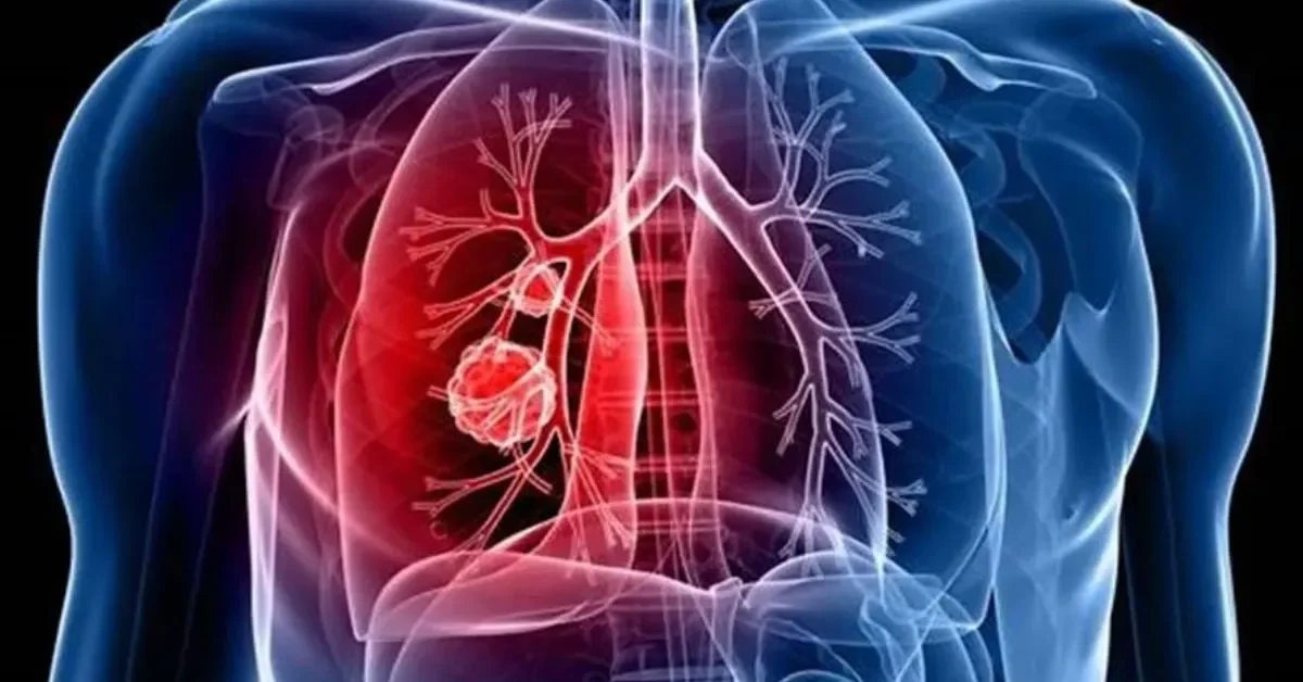 Lung - Cancer - – - गैर - धूम्रपान - करने - वालों - में