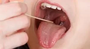 Oral - Cancer - – - तीन - हफ्ते - से - न - भरने