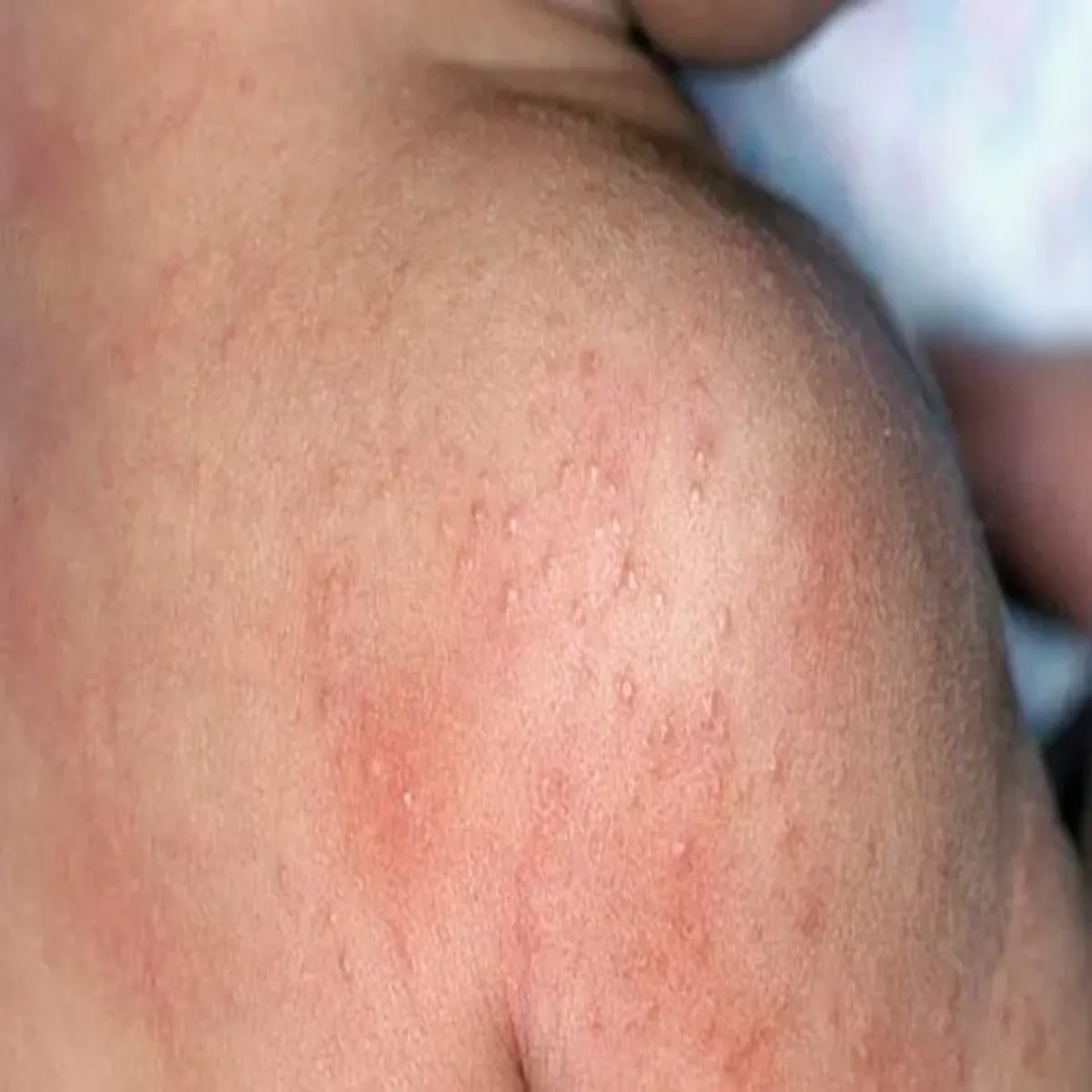 Pricklyheat Pricklyheat Grmiyon Men Ghmauriyon Raht