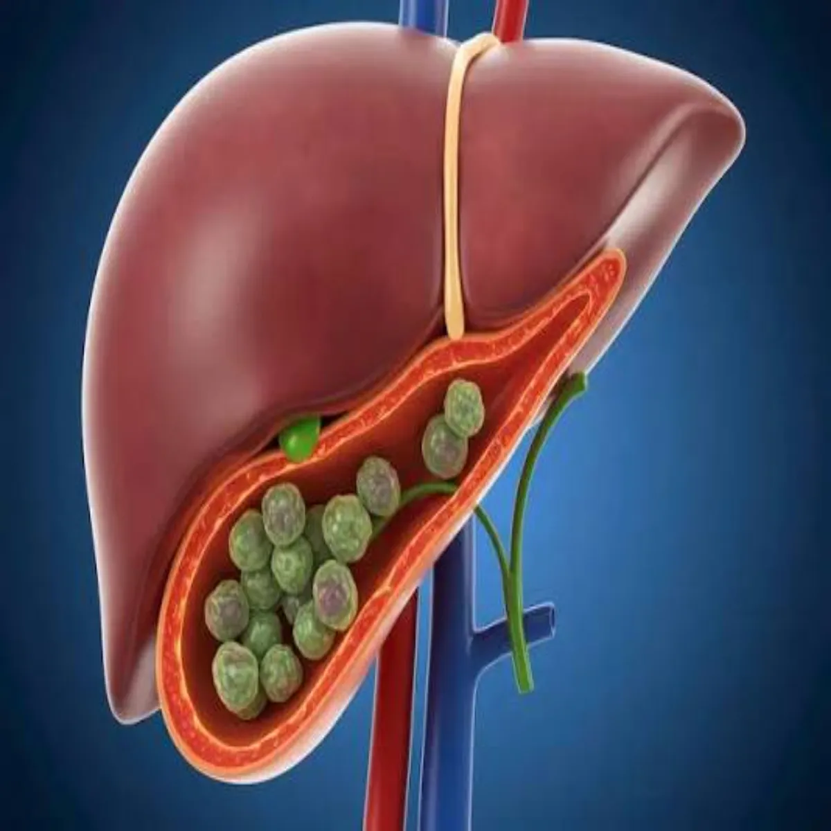 Gallbladderstone Gallbladderstone Pittashy Pthri Njrandaj Krna