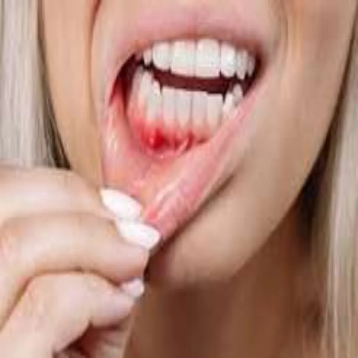 Mouthulcers Mouthulcers Munh Chhalon Men Apnaen