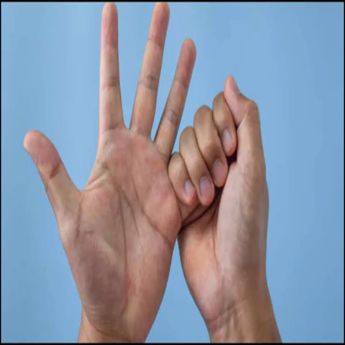 Neuropathy Neuropathy Chhoti Ungli Men Jhnjhnaht