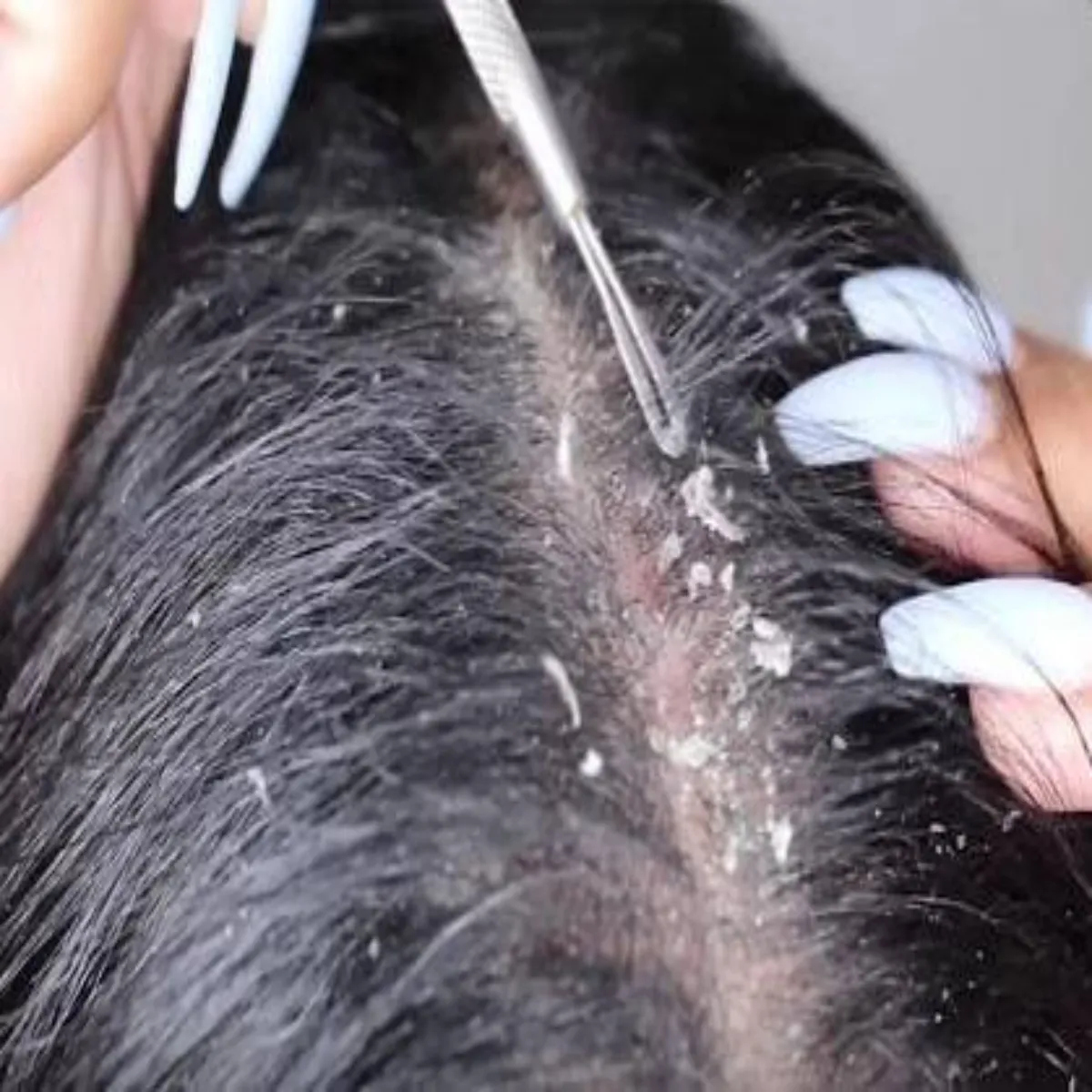 Dangerous Dandruff Signs Dangerous Dandruff Signs