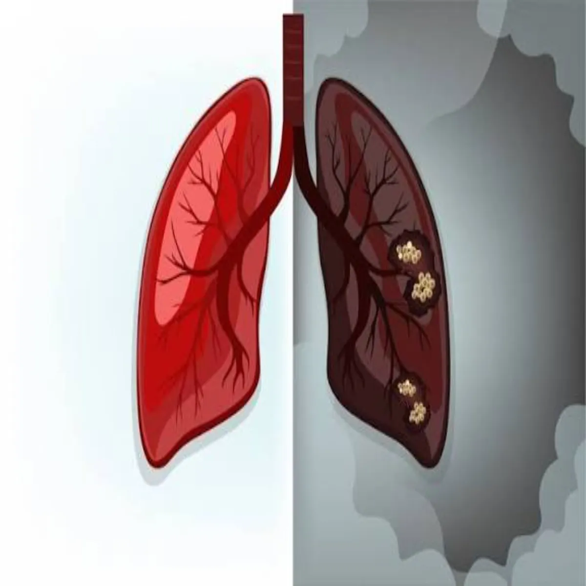Lungcancer Lungcancer Phephdon Kainsr Chr Smjhen