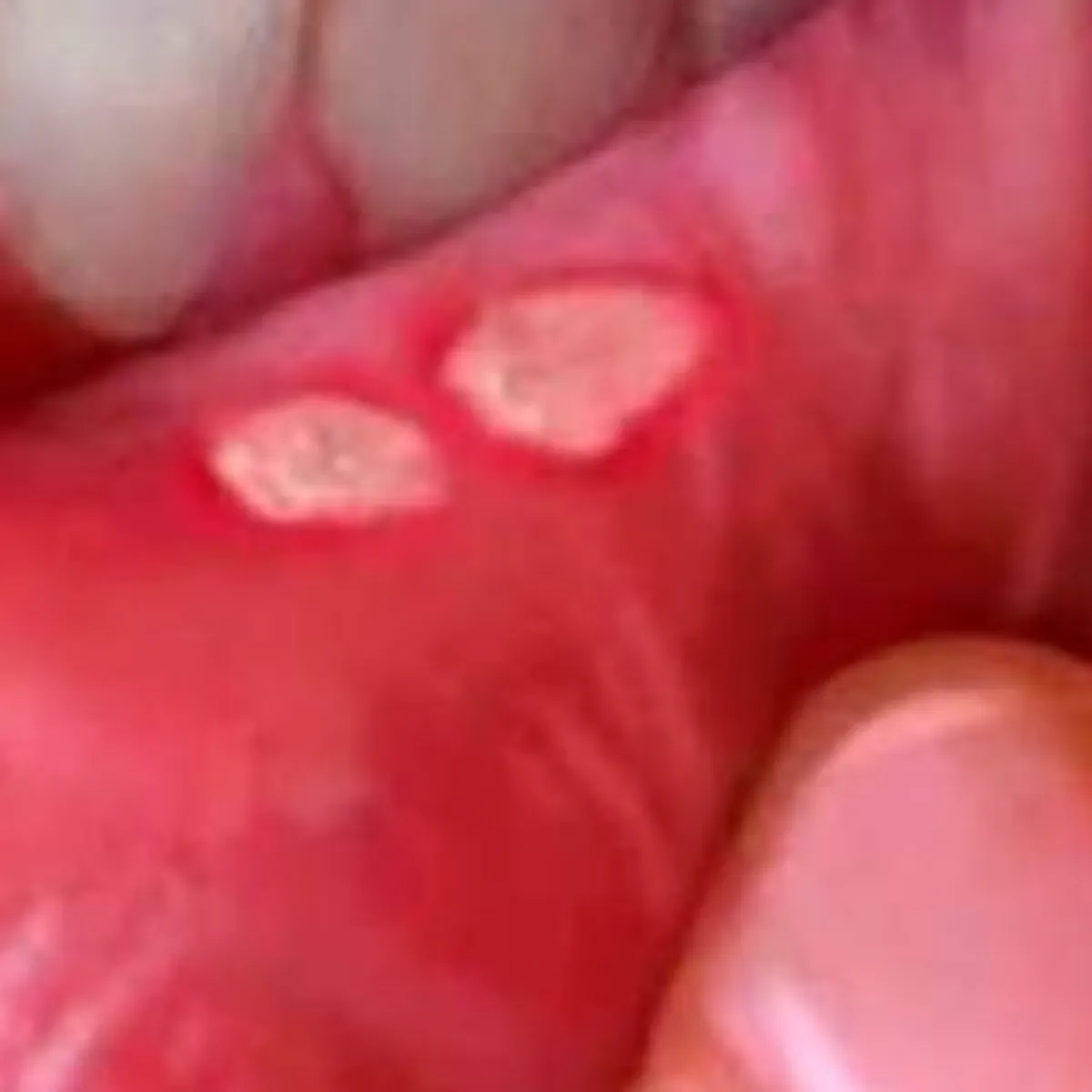Mouthulcer Mouthulcer Bar Munh Men Chhale